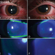 Slit-lamp photography of both eyes of one patient who developed inflamed corneas after exposure to a UV lamp.